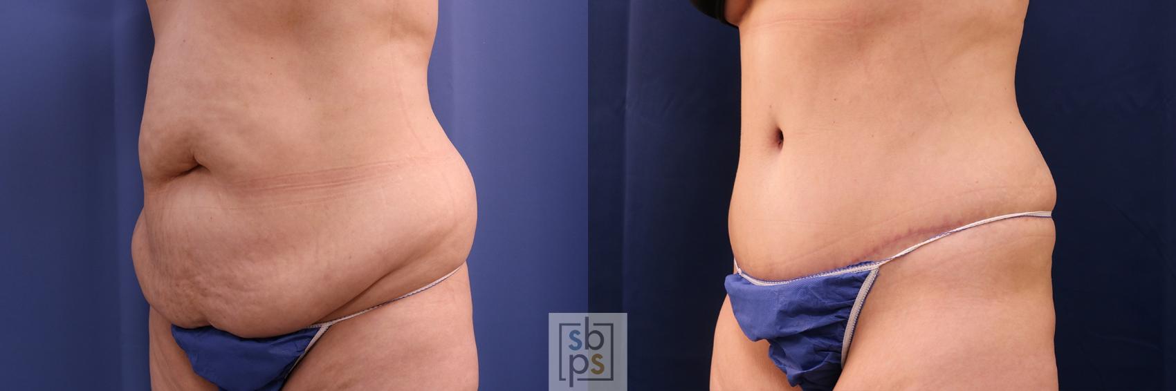 Before & After Liposuction Case 522 Left Oblique View in Torrance, CA