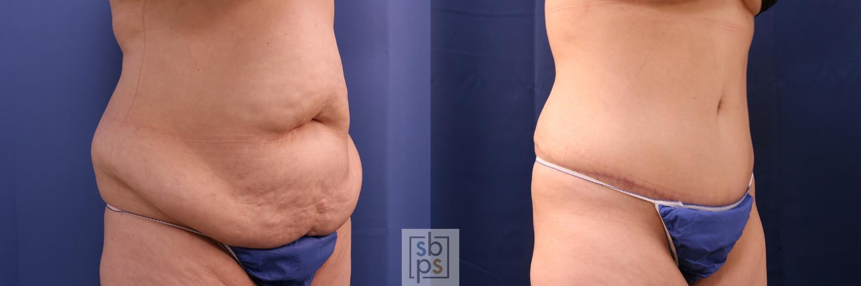 Before & After Liposuction Case 522 Right Oblique View in Torrance, CA