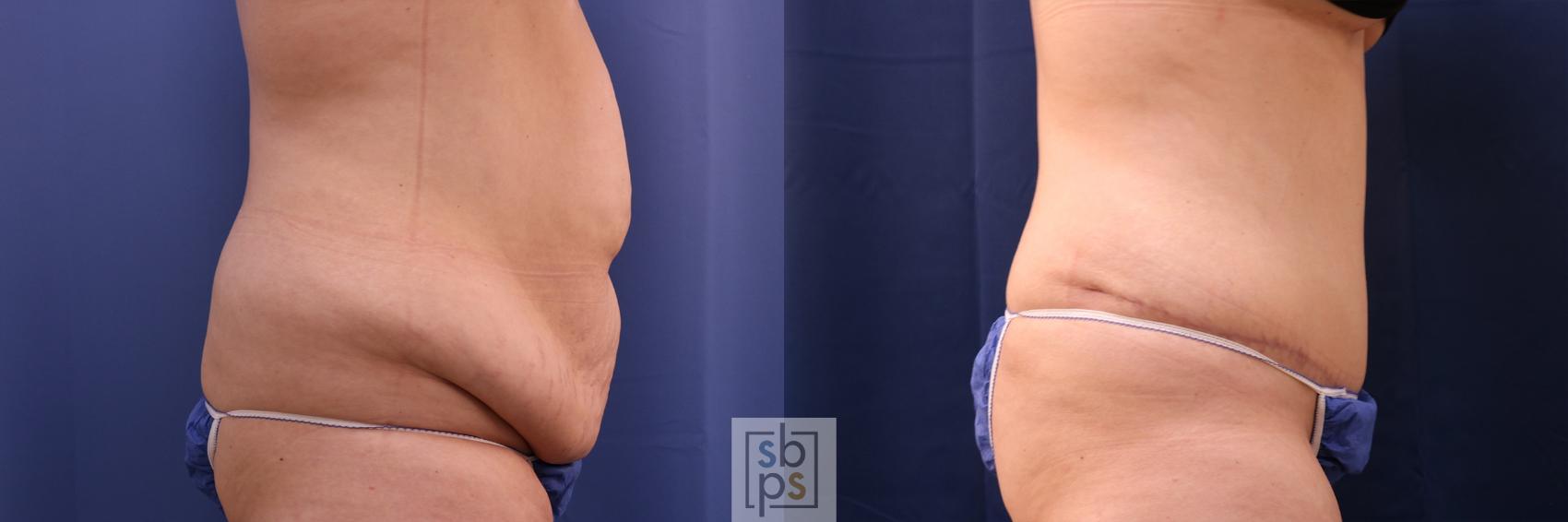 Before & After Liposuction Case 522 Right Side View in Torrance, CA