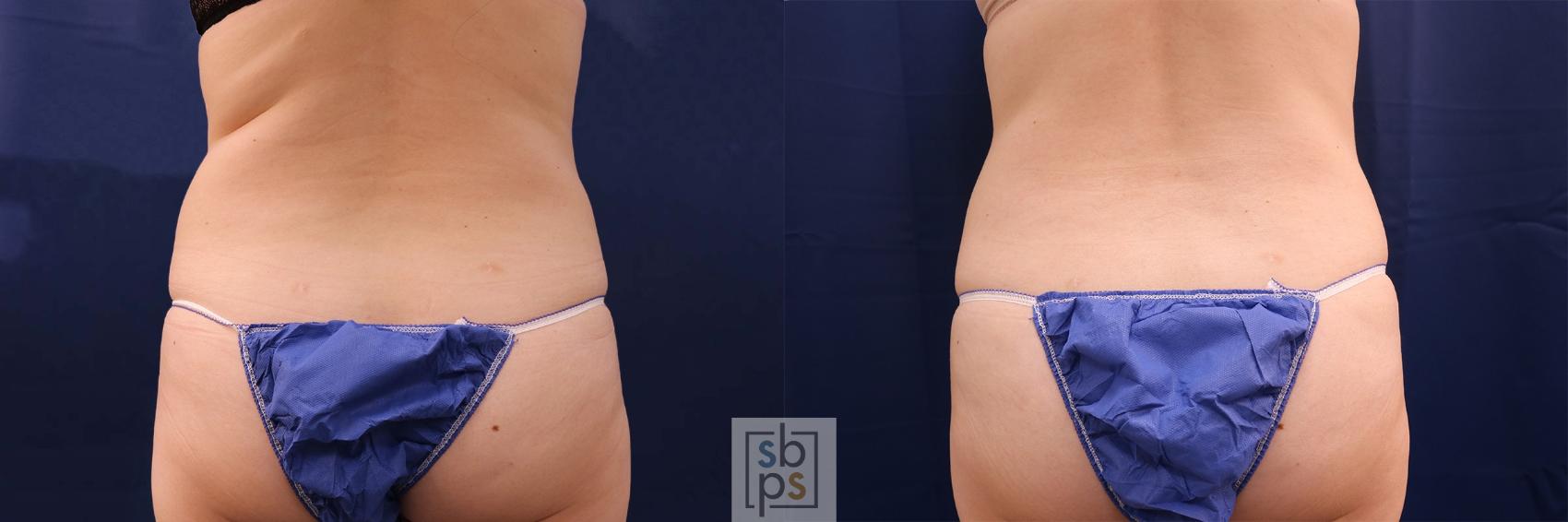 Before & After Tummy Tuck Case 550 Back View in Torrance, CA