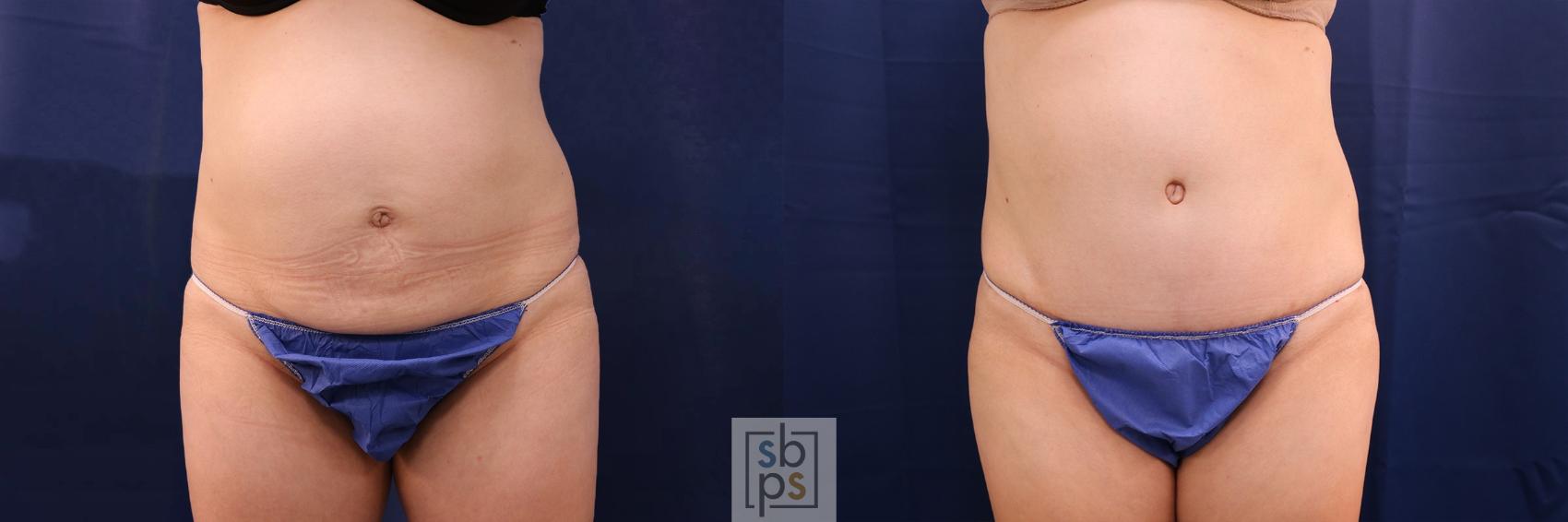Before & After Tummy Tuck Case 550 Front View in Torrance, CA