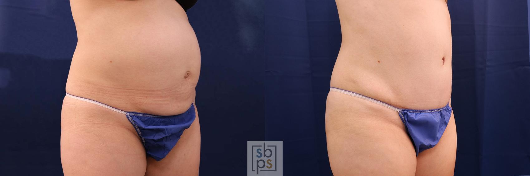 Before & After Tummy Tuck Case 550 Right Oblique View in Torrance, CA