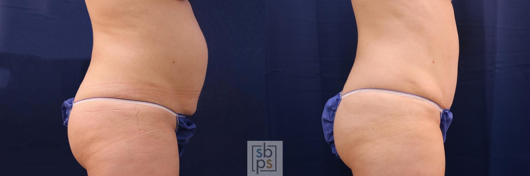 Before & After Tummy Tuck Case 550 Right Side View in Torrance, CA