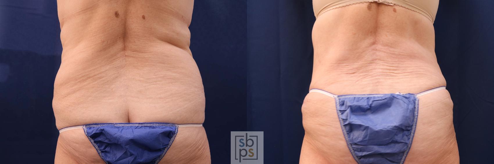 Before & After Tummy Tuck Case 552 Back View in Torrance & Los Angeles, CA, CA