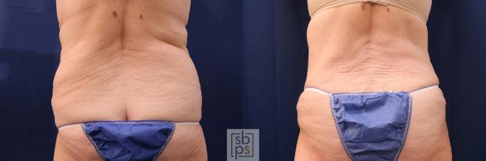 Before & After Tummy Tuck Case 552 Back View in Torrance, CA