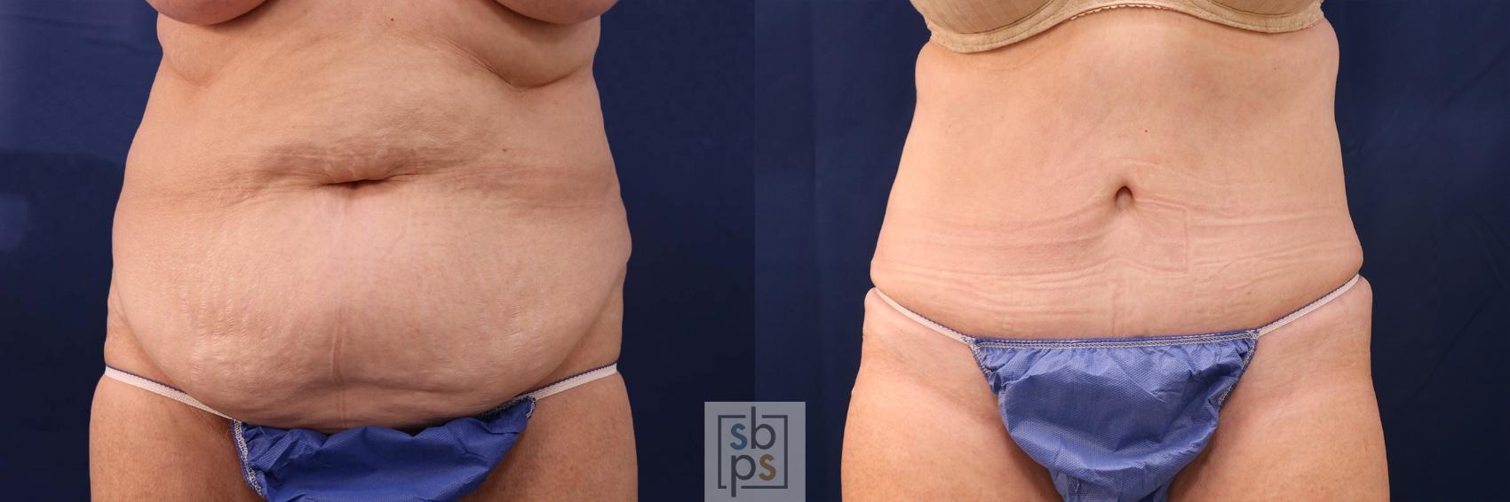Before & After Tummy Tuck Case 552 Front View in Torrance, CA