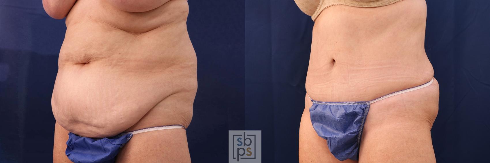 Before & After Tummy Tuck Case 552 Left Oblique View in Torrance & Los Angeles, CA, CA