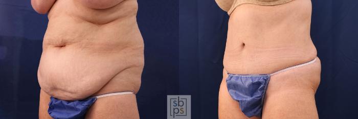 Before & After Tummy Tuck Case 552 Left Oblique View in Torrance, CA