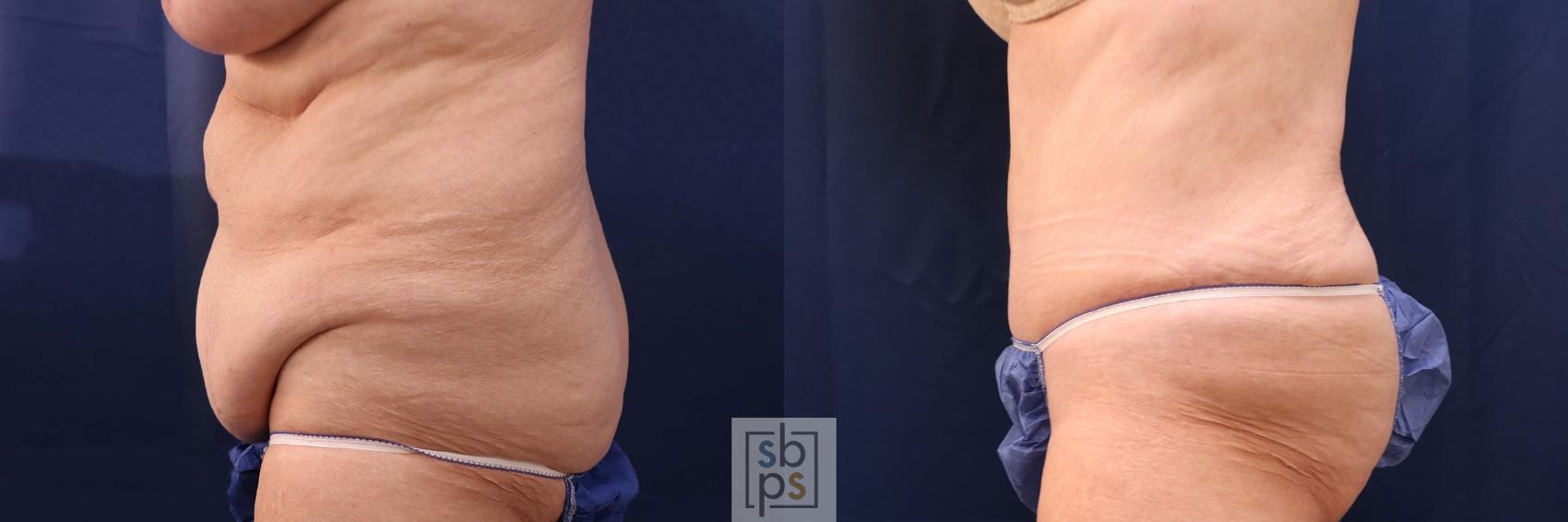 Before & After Tummy Tuck Case 552 Left Side View in Torrance & Los Angeles, CA, CA