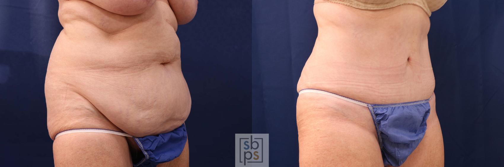 Before & After Tummy Tuck Case 552 Right Oblique View in Torrance & Los Angeles, CA, CA