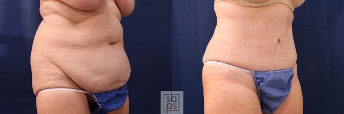 Before & After Tummy Tuck Case 552 Right Oblique View in Torrance, CA