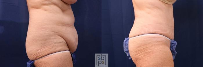 Before & After Tummy Tuck Case 552 Right Side View in Torrance, CA