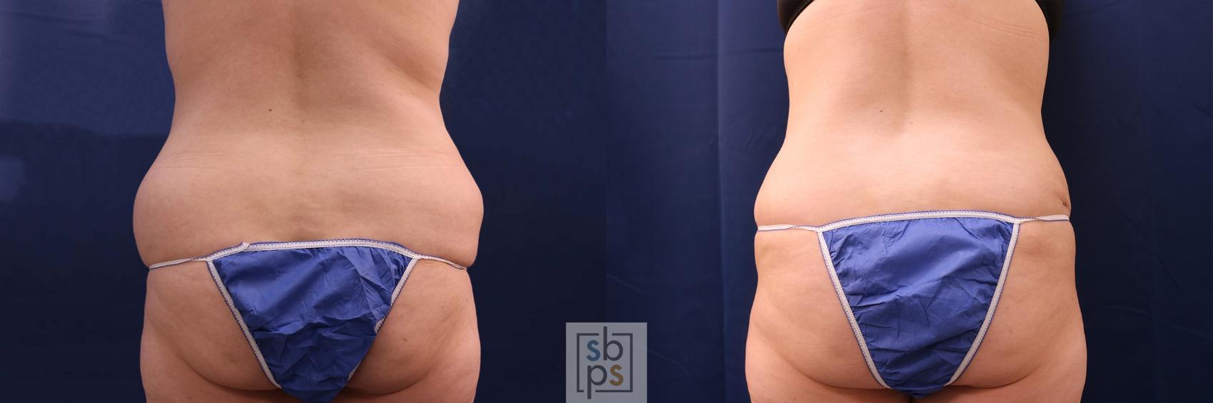 Before & After Tummy Tuck Case 553 Back View in Torrance & Los Angeles, CA, CA