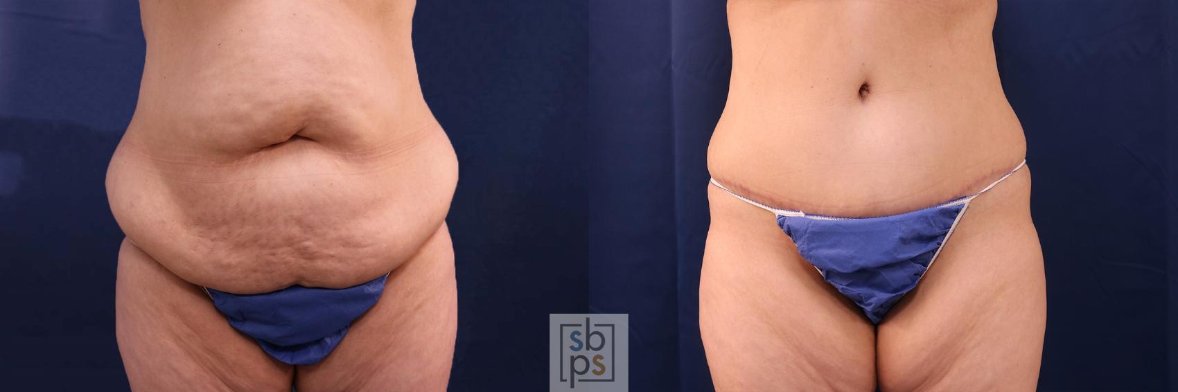 Before & After Tummy Tuck Case 553 Front View in Torrance, CA
