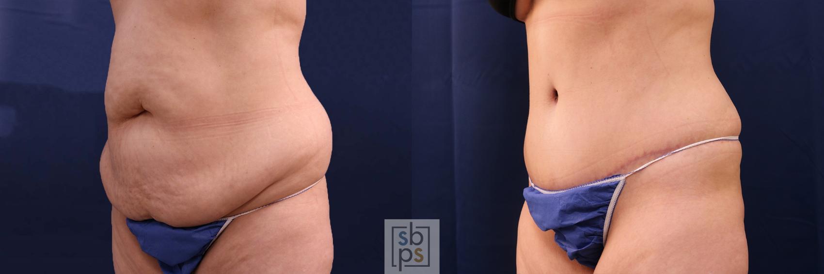 Before & After Tummy Tuck Case 553 Left Oblique View in Torrance & Los Angeles, CA, CA
