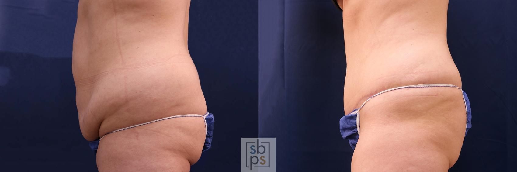 Before & After Tummy Tuck Case 553 Left Side View in Torrance & Los Angeles, CA, CA