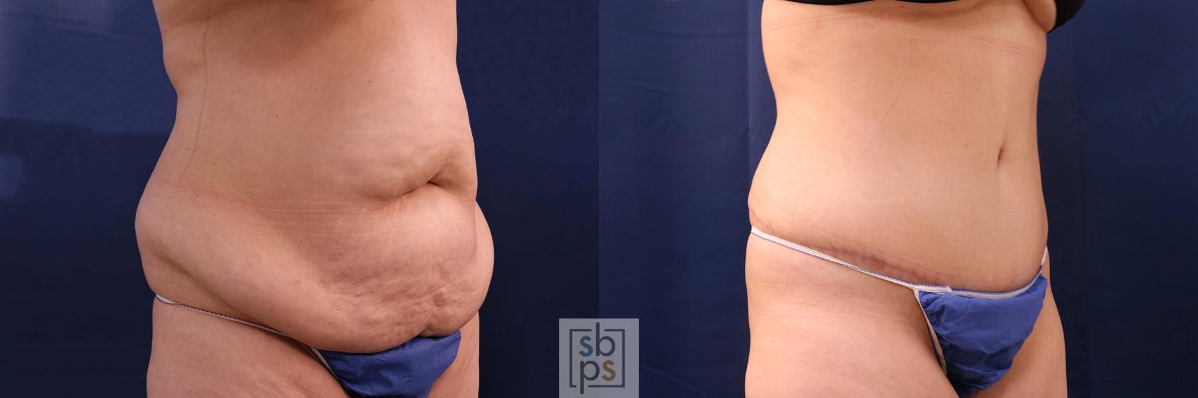Before & After Tummy Tuck Case 553 Right Oblique View in Torrance & Los Angeles, CA, CA