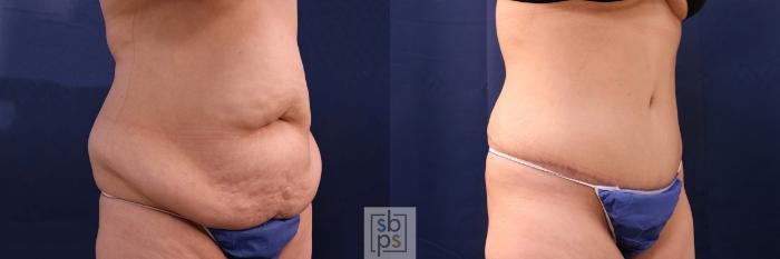 Before & After Tummy Tuck Case 553 Right Oblique View in Torrance, CA