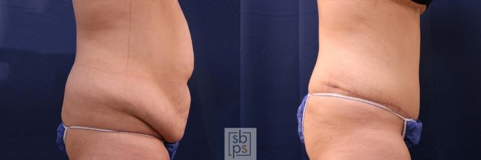 Before & After Tummy Tuck Case 553 Right Side View in Torrance, CA