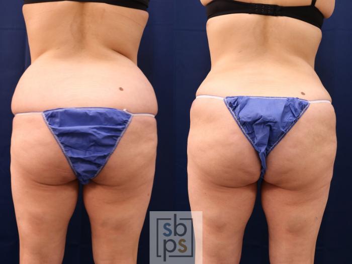 Before & After Buttock Augmentation Case 559 Back View in Torrance, CA
