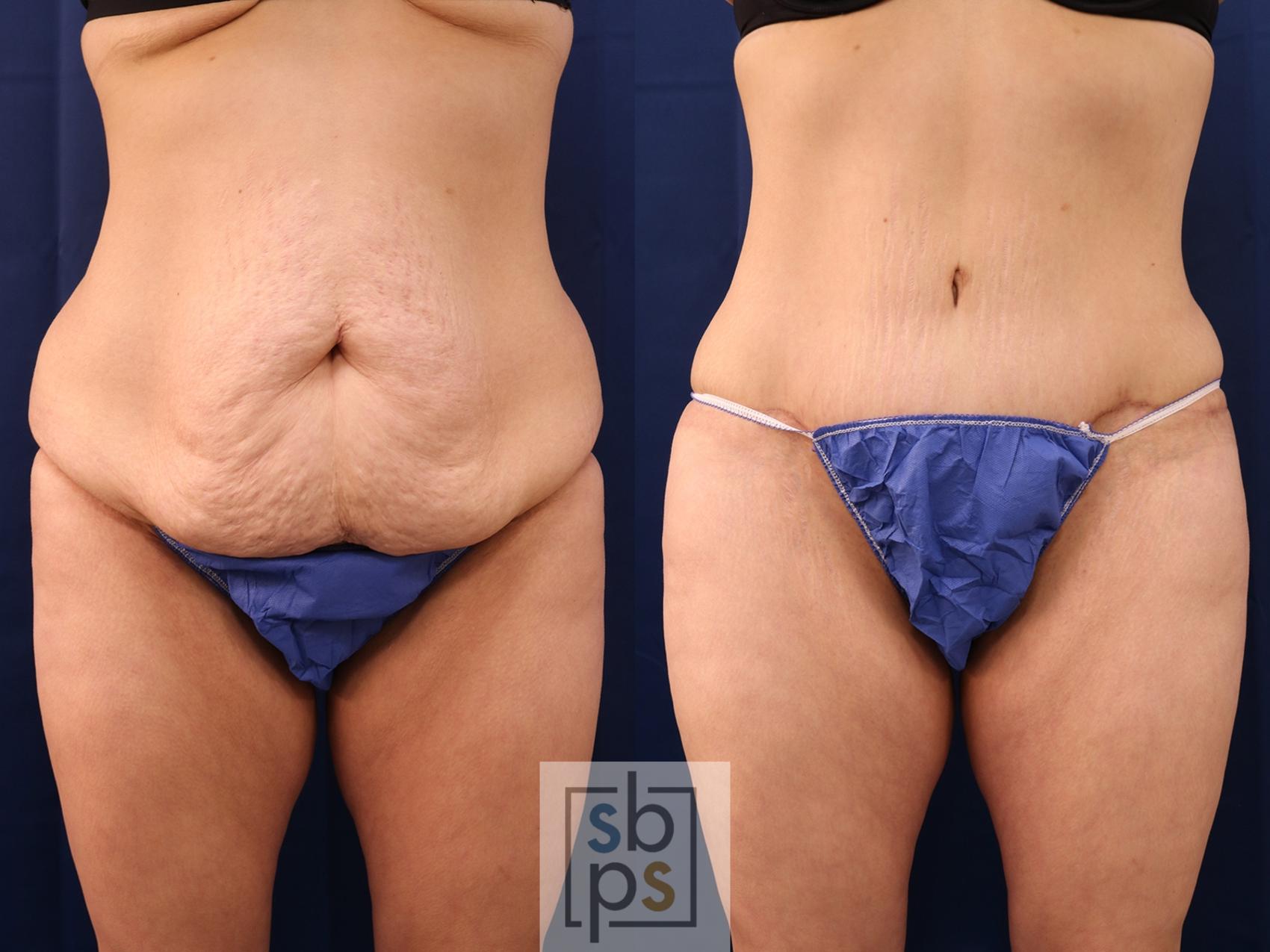 Before & After Tummy Tuck Case 559 Front View in Torrance, CA