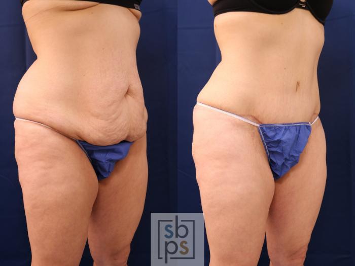 Before & After Tummy Tuck Case 559 Left Oblique View in Torrance, CA