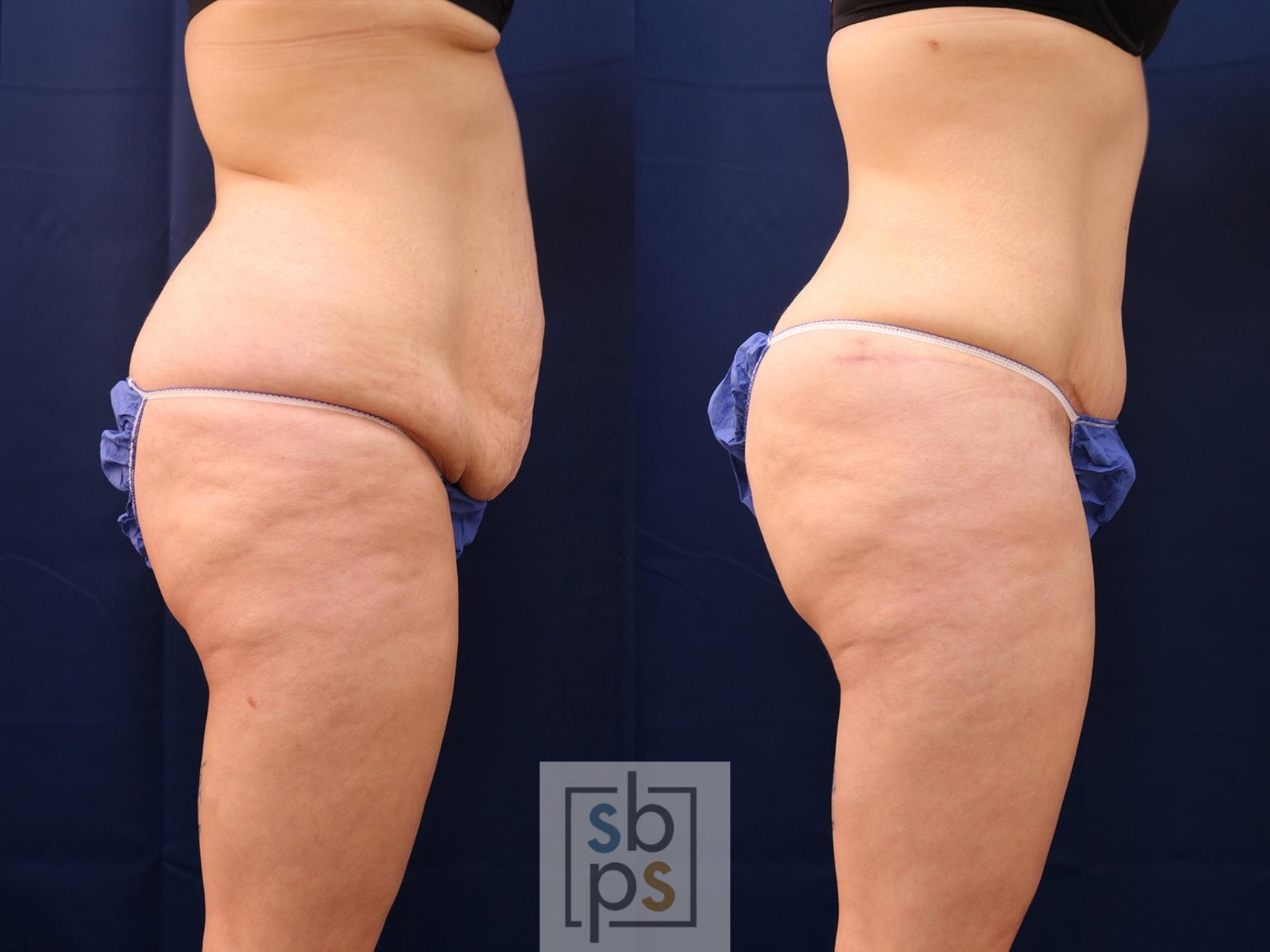 Before & After Tummy Tuck Case 559 Left Side View in Torrance, CA