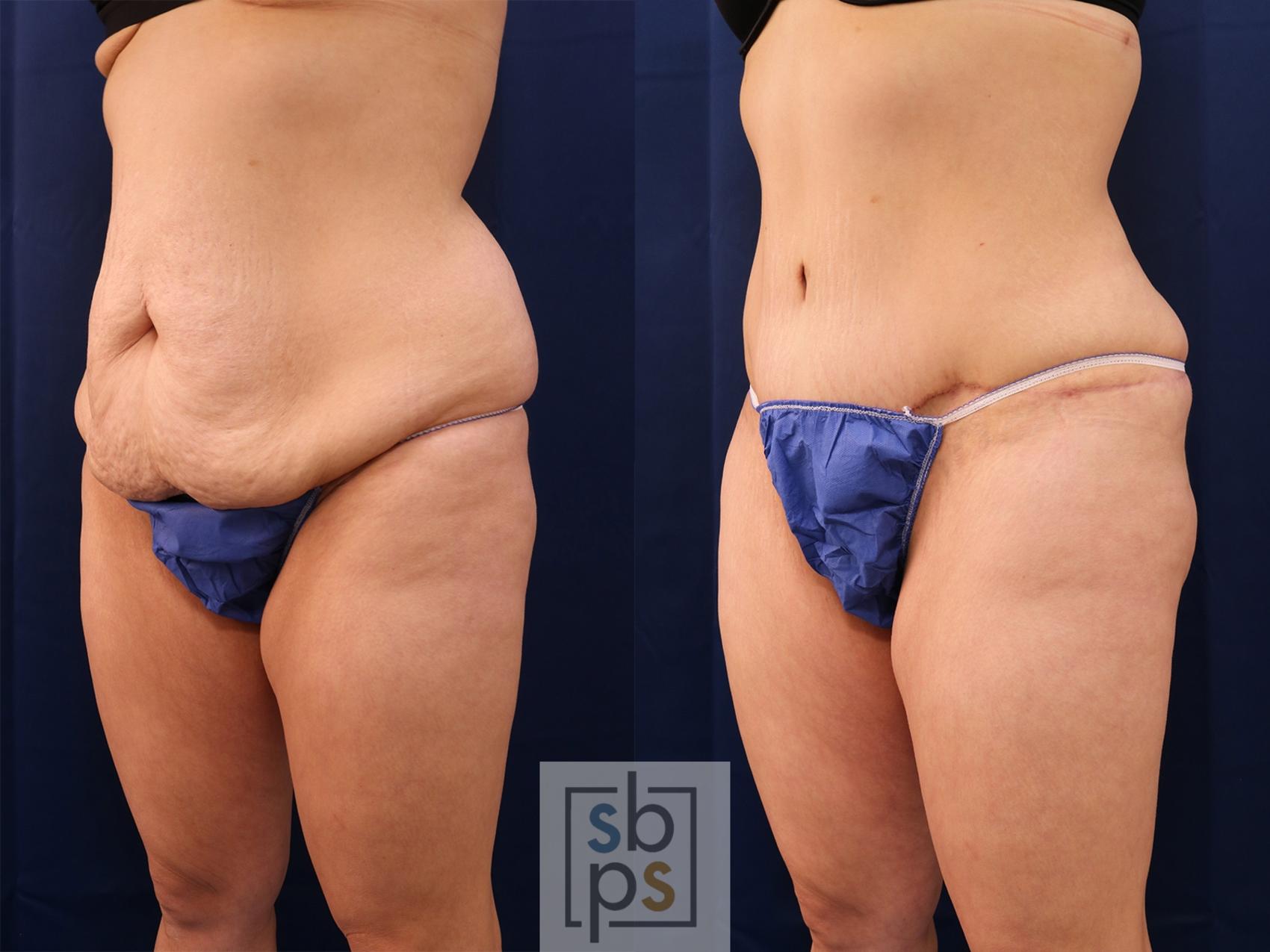 Before & After Tummy Tuck Case 559 Right Oblique View in Torrance & Los Angeles, CA, CA