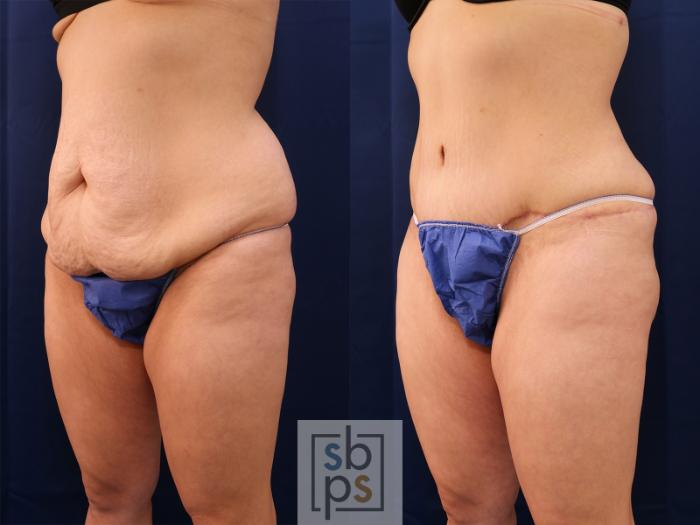 Before & After Tummy Tuck Case 559 Right Oblique View in Torrance, CA