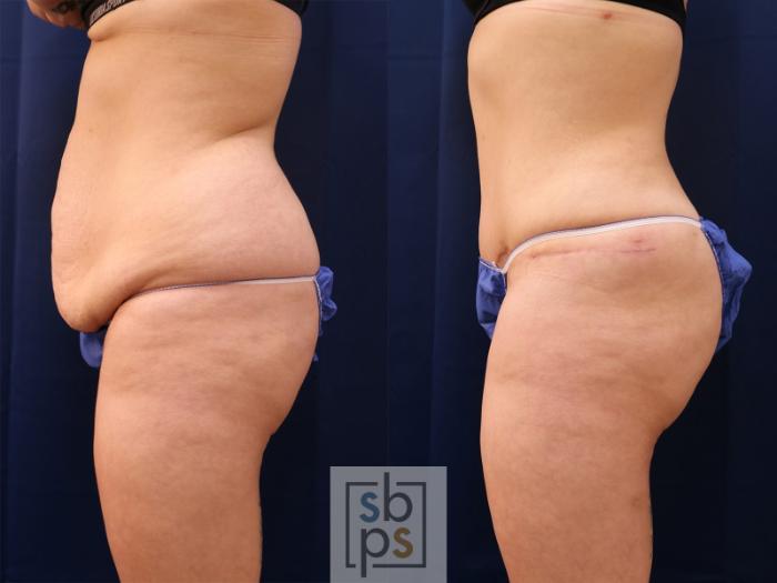 Before & After Liposuction Case 559 Right Side View in Torrance, CA