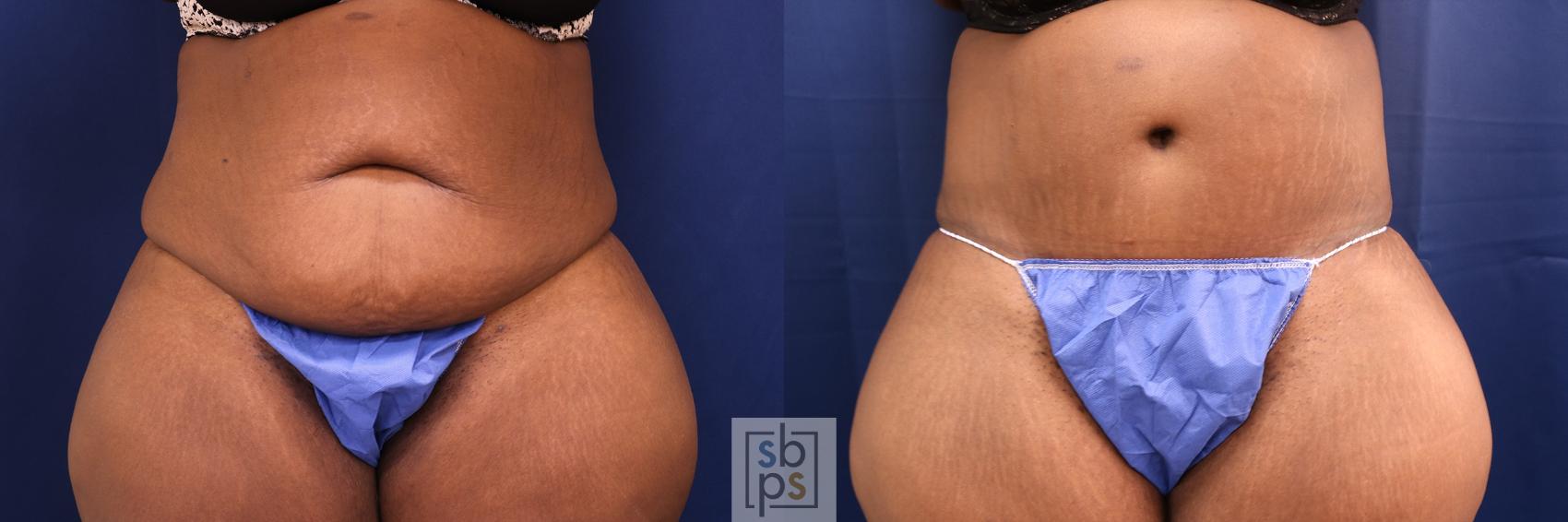 Before & After Tummy Tuck Case 567 Front View in Torrance, CA