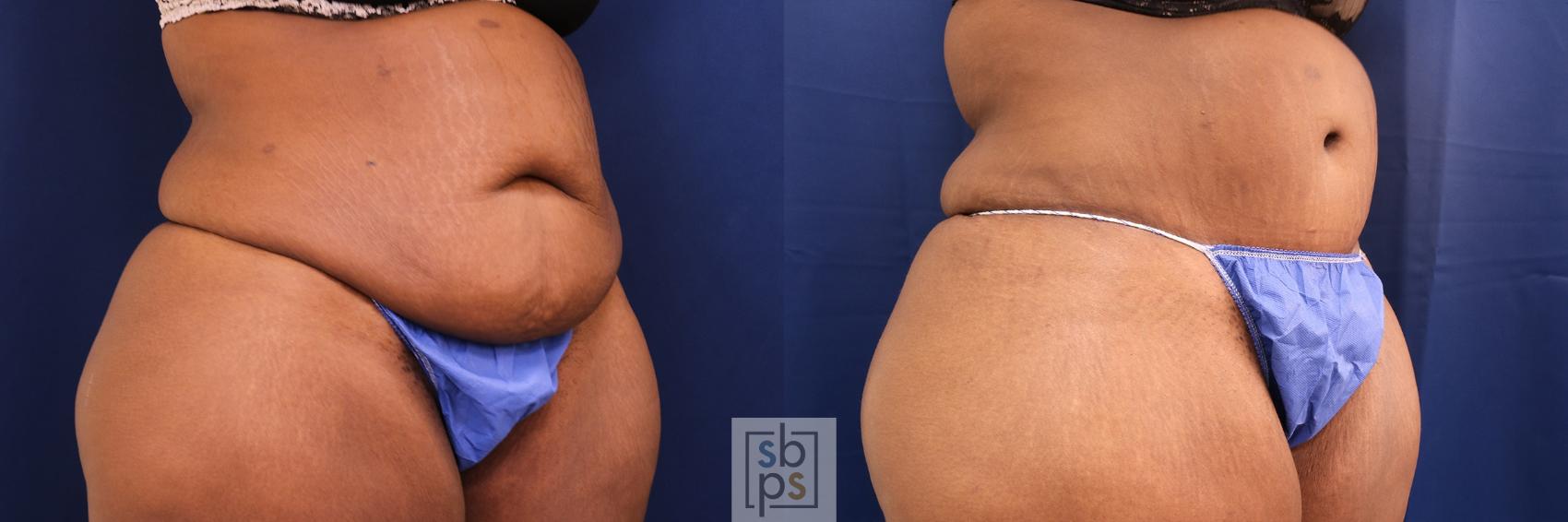 Before & After Tummy Tuck Case 567 Left Oblique View in Torrance & Los Angeles, CA, CA