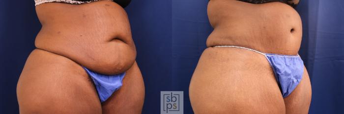 Before & After Tummy Tuck Case 567 Left Oblique View in Torrance, CA