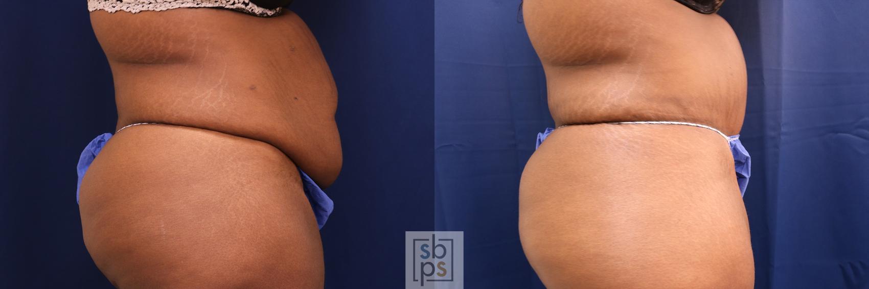 Before & After Tummy Tuck Case 567 Left Side View in Torrance & Los Angeles, CA, CA