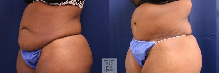 Before & After Tummy Tuck Case 567 Right Oblique View in Torrance, CA