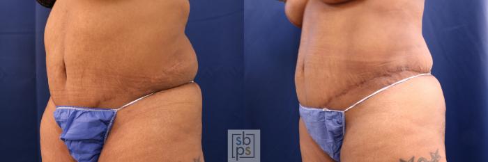 Before & After Tummy Tuck Case 573 Left Oblique View in Torrance, CA