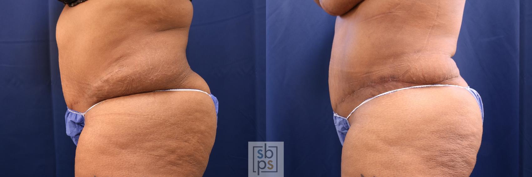 Before & After Tummy Tuck Case 573 Left Side View in Torrance & Los Angeles, CA, CA