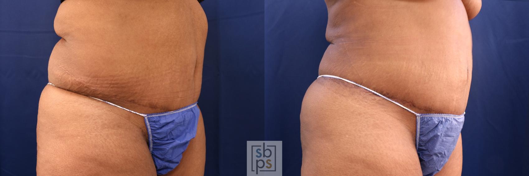 Before & After Tummy Tuck Case 573 Right Oblique View in Torrance & Los Angeles, CA, CA