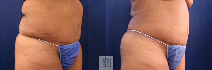 Before & After Tummy Tuck Case 573 Right Oblique View in Torrance, CA
