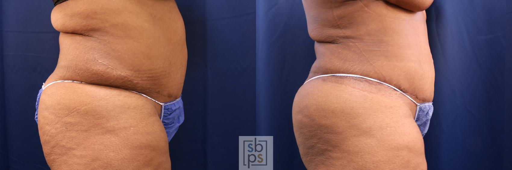 Before & After Tummy Tuck Case 573 Right Side View in Torrance & Los Angeles, CA, CA