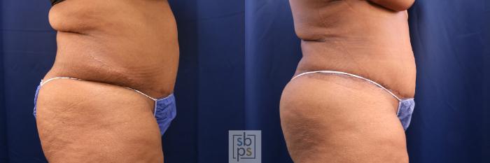 Before & After Tummy Tuck Case 573 Right Side View in Torrance, CA