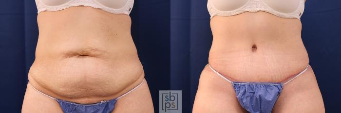 Before & After Tummy Tuck Case 575 Front View in Torrance, CA
