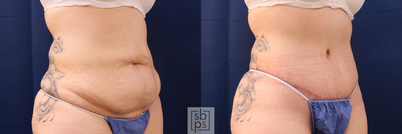 Before & After Tummy Tuck Case 575 Left Oblique View in Torrance, CA