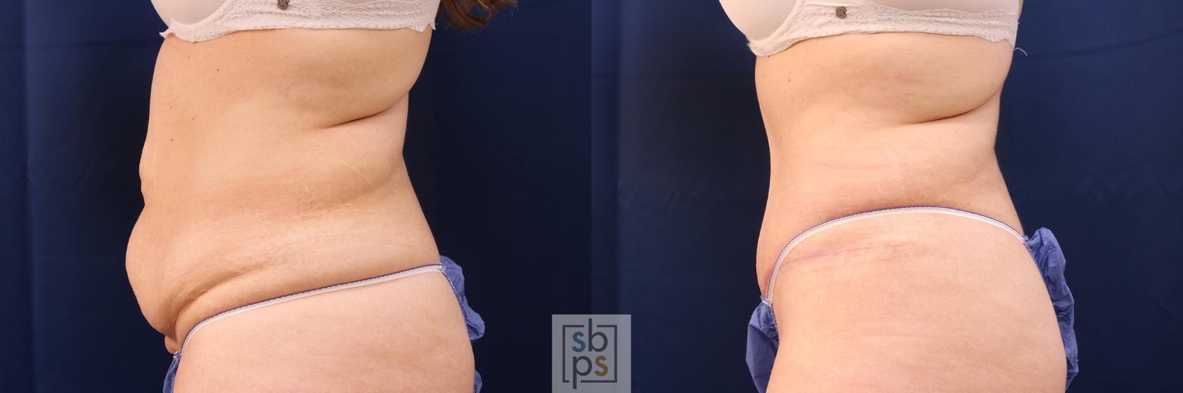 Before & After Tummy Tuck Case 575 Left Side View in Torrance, CA