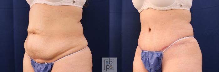 Before & After Tummy Tuck Case 575 Right Oblique View in Torrance, CA