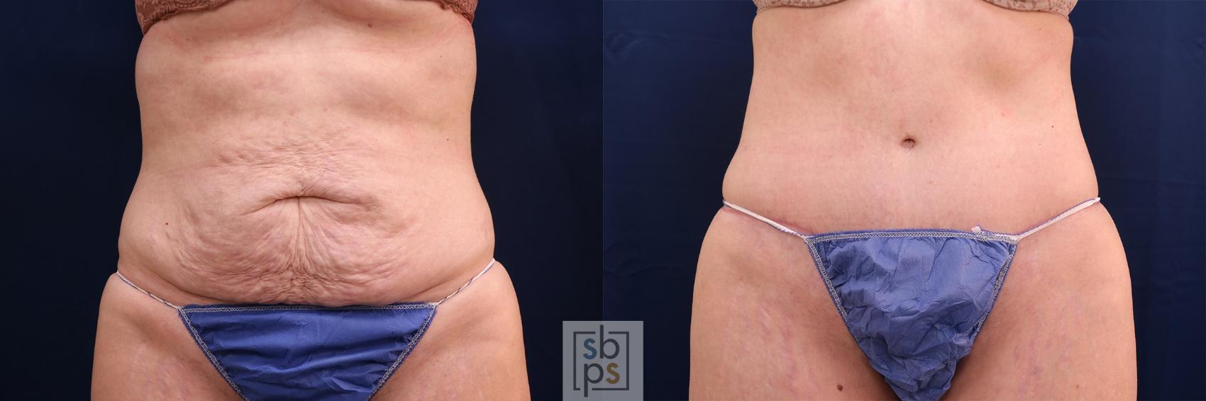 Before & After Tummy Tuck Case 580 Front View in Torrance, CA