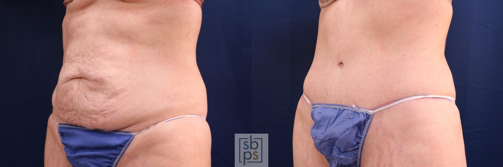 Before & After Tummy Tuck Case 580 Left Oblique View in Torrance, CA