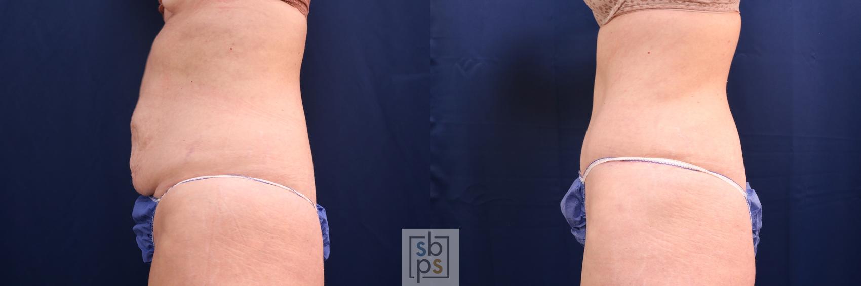 Before & After Tummy Tuck Case 580 Left Side View in Torrance, CA
