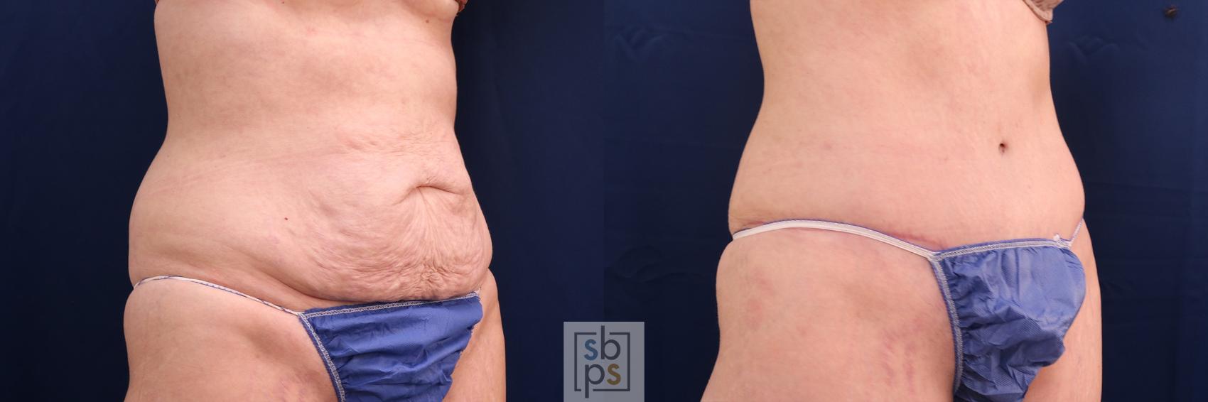Before & After Tummy Tuck Case 580 Right Oblique View in Torrance, CA