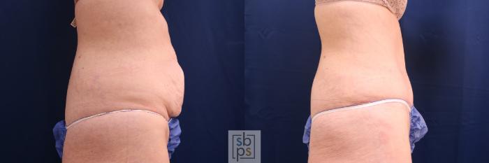 Before & After Tummy Tuck Case 580 Right Side View in Torrance, CA
